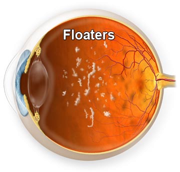 Eyes+Floaters+Causes Vitreous Floaters - Mosche volanti - Floaters